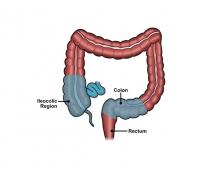 Enfermedad crohn